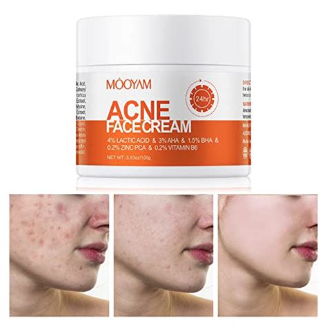 teen cream|Acne Treatment for Teens: OTC and Prescription.